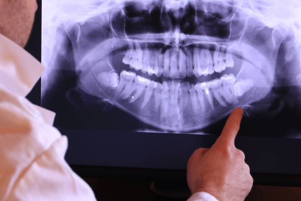 Best Emergency Wisdom Teeth Removal in Stanton, TX