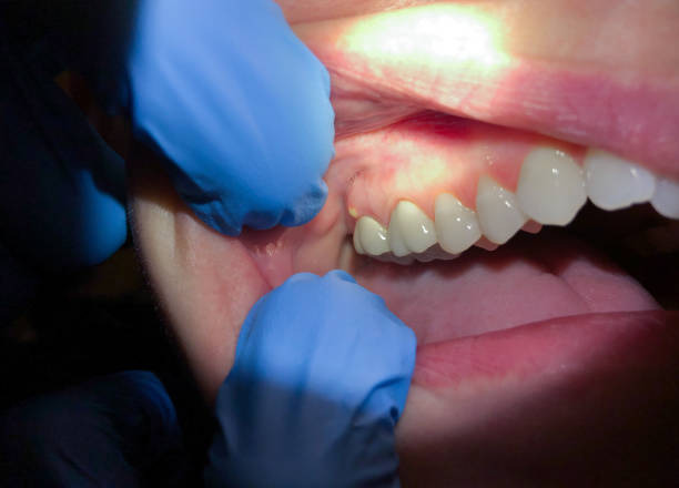 Best Emergency Gum Treatment in Stanton, TX